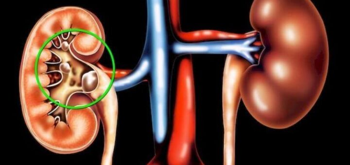 Камені в нирках: продукти, які провокують їх появу